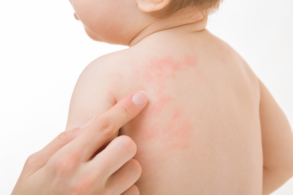 رایج‌ترین حساسیت‌های پوستی نوزادان و روش‌های درمان آن‌ها